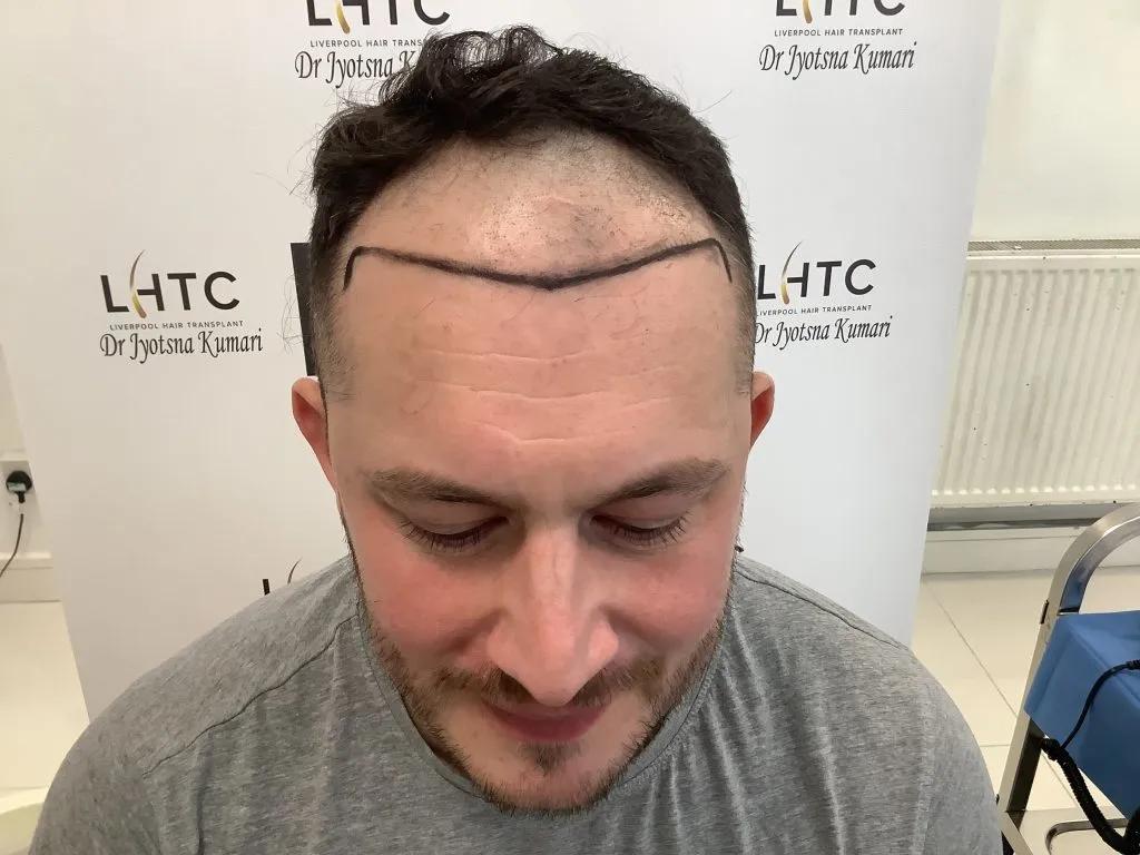 What Makes Hair Transplant UK Liverpool a Popular Choice for Hair Restoration?